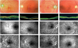 Fundoscopy demonstrated serous detachment in the lower temporal region (A) of the left eye near the vascular arch and just below the fovea, although the detachment was better observed using OCT (B). Fluorescein angiography showed peripapillary hyperfluorescence (C-D). The serous detachment improved after anti-HP treatment, and the leaks were found to be diminished (E-H). Fundoscopy revealed serous detachment in the papillomacular bundle of the right eye (I). Serous detachment was observed using OCT from the nasal region to the fovea of the right eye (J). Fluorescein angiography showed peripapillary hyperfluorescence (K-L). Serous detachment improved after anti-HP treatment, and the leaks were found to be diminished (M-P).