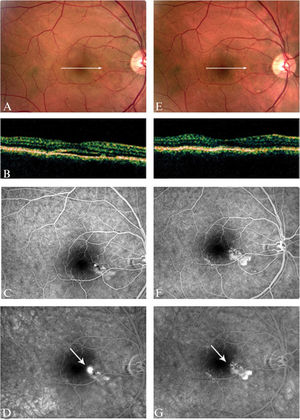 A patient with a six-month history of CSC and macular serous detachment (A-B). Fluorescein angiography showed RPE changes and a juxtafoveal leak (arrow), precluding regular laser treatment (C-D). The serous detachment improved after anti-HP treatment (E-F), and fluorescein angiography showed prominent resolution of the leakage with persistence of the RPE changes (G-H).