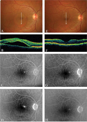 A patient with a three-month history of recurrent CSC. Fundoscopy and OCT revealed serous detachment in the macular area (A-B). Fluorescein angiography showed a parafoveal leak in the papillomacular bundle (C-D). The serous detachment and the leak were both resolved after anti-HP treatment (E-H).