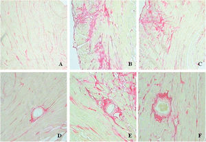 Interstitial collagen deposition in control (A), infected (B), and carvedilol groups (C). Collagen is stained in red by picrosirius red. Collagen deposition in the perivascular space in control (D), infected (E), and carvedilol (F) groups.