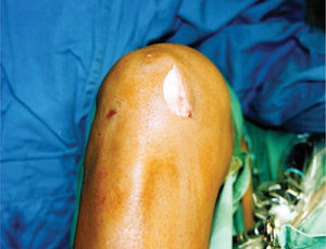 Post-arthroscopic approach: skin incision in the medial parapatellar region of the knee
