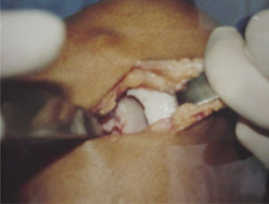 Osteochondral lesion in a weight-bearing area of the medial femoral condyle.