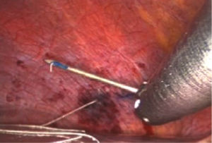 Laparoscopic implantation of an intra-diaphragm phrenic stimulation electrode in the right hemidiaphragm.
