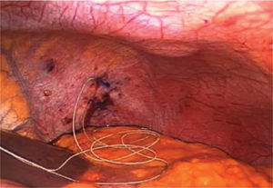 Laparoscopic view of an intra-diaphragm phrenic stimulation electrode successfully implanted in the left hemidiaphragm.