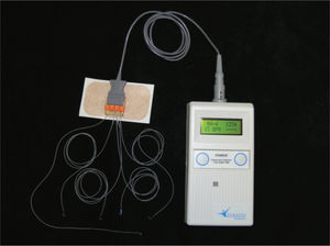 The diaphragmatic intramuscular electrodes attached to the NeuRx pacing device.
