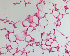 Histopathology of lungs preserved for 6 hours with Perfadex. Sites of mild alveolar edema can be observed (white asterisks). Similar findings were observed in Celsior-preserved lungs (hematoxylin-eosin, 200X magnification).
