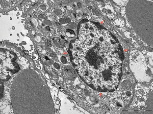 Pneumocyte with a tendency for peripheral chromatin aggregation that is compatible with ongoing apoptosis (red arrows) (transmission electron microscopy, 8900X magnification).