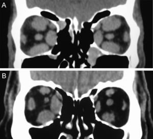 Coronal CT scans from two patients with Graves’ orbitopathy. A) Patient with symmetric enlargement of the extraocular muscles in both orbits. B) Patient with asymmetric involvement of the extraocular muscles.