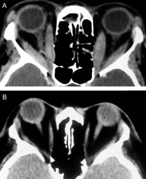 Axial CT scans from two patients with Graves’ orbitopathy. A) Patient with prominent enlargement of the medial and lateral recti muscles. B) Patient with severe proptosis of both orbits with clear fat tissue augmentation and no extraocular muscle involvement.