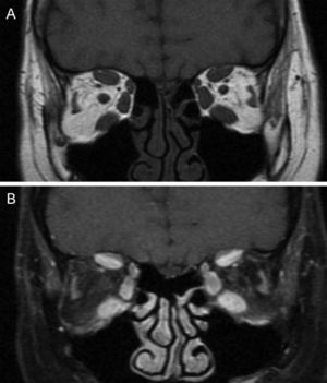 Coronal T1-weighted MR images from a patient with active Graves’ orbitopathy. A) Image showing enlargement of the extraocular muscles without fatty degeneration. B) Fat-suppressed and gadolinium-enhanced image showing a bright signal from the inferior, medial and superior recti muscles.