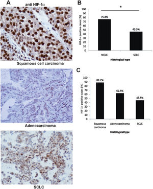 HIF-1α immunostaining in lung carcinoma specimens. A) Strong nuclear and weak cytoplasmic HIF-1α staining in squamous cell carcinoma, HIF-1α nuclear staining in adenocarcinoma cells and HIF-1α nuclear staining in SCLC (immunoperoxidase staining, original magnification ×400). B) Percentage of HIF-1α-positive samples in NSCLC compared to SCLC samples (p = 0.022). C) Percentage of HIF-1α-positive samples in squamous cell carcinoma, adenocarcinoma and SCLC.