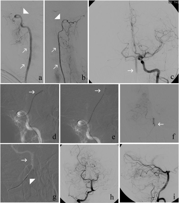 Mechanical thrombectomy with solitaire stent retrieval for acute ...