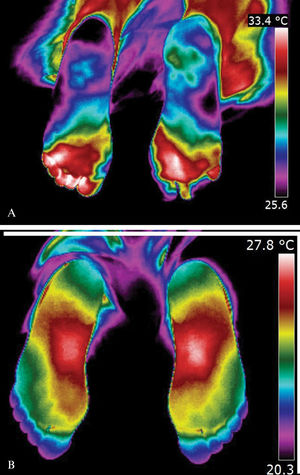 (A) Plantar thermographic image in a diabetic patient, showing Interdigital Anisothermal (the white arrow shows the different colors in toes meaning ΔT ≥ 0.4°C). (B) Plantar thermographic image in a control subject, with regular thermal distribution, without Interdigital Anisothermal (color gradient of toes considered normal, ΔT < 0.4°C).
