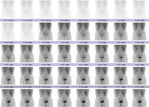 A Tc99m DTPA perfusion scintigraphy revealed a delay in the initiation of perfusion and deterioration of function for both kidneys, affecting left kidney particularly.