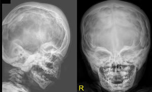 Lateral skull and AP radiographs show marked cranial osteosclerosis and hyperostosis. The facial bones and base of the skull are severely hyperostosed.