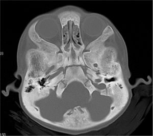 Axial CT scanning shows progressive and bilateral narrowing of the optic canal.