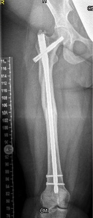Anteroposterior lower extremity (retrospective) radiographs show mild diaphyseal hyperostosis associated with mid-diaphyseal fractures and locked intramedullary nailing.