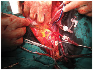 During surgery, the right coronary artery ostium was not observed.