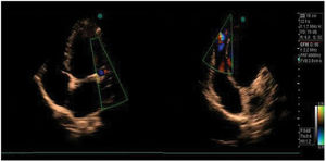 A transthoracic echocardiogram showing the markedly dilated left coronary artery (left) and an abnormal flow to the right ventricle, suggesting the diagnosis of a coronary fistula to a right cardiac chamber (right).