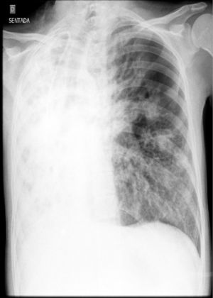 Chest X-ray showing a diffuse opacity of the right lung that is compatible with atelectasis.