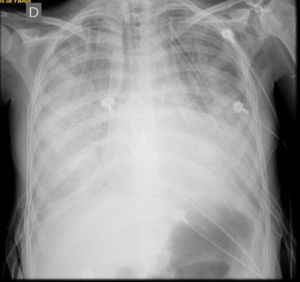 Chest X-ray immediately after orotracheal intubation showing diffuse bilateral opacities that are compatible with primary graft dysfunction after lung transplantation
