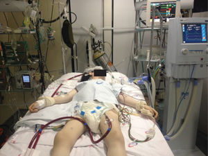 A patient in intensive care receiving mechanical ventilation and ECMO therapy.