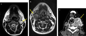 Shamblin classification. The Shamblin classification is based on involvement of the carotid arteries, which are shown by white arrows in A–C. The tumors are indicated by yellow arrows. (A) CBT (class I): the axial T2-weighted MRI shows a CBT in a typical location. Bulging of the left carotid bifurcation without any encasement of the carotid vessels. (B) CBT (class II): axial T2-weighted MRI showing a right-sided CBT with a partial encasement of the internal and external carotid artery. (C) CBT (class III): an axial slice of CT-angiography reveals a huge left-sided CBT with a complete encasement of the carotid vessels. In this case, bone destruction of the skull base, attributed to the enormous CBT, was also detected by CT (not shown).