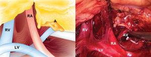Left-side retroperitoneoscopic view. A: adrenal. AV: adrenal vein. LV: lumbar vein. RA: renal artery. RV: renal vein. Note the laparoscopic clips for the inferior and medial adrenal arteries.