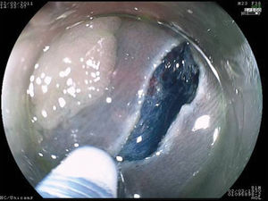 Initial submucosal dissection after injection with indigo carmin.