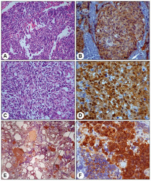 catenin IHC findings in three representative medulloblastoma cases. Large-cell variant presenting anaplastic cells in HE (A, 200x), with the majority of cells presenting positive cytoplasmic β-catenin reactions but few cell showing positive nuclear reactions (B, 400x). Large-cell variant with abundant clear cells in HE (C, 400x) and several positive nuclei intermingled with a small number of cells presenting a negative cytoplasmic reaction (D, 600x). Extensive nodularity variant presenting an islet of positive cells (E, 40x) with strong nuclear reactivity but lower cytoplasmic reactivity (F, 600x).