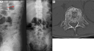 Example of a clinical case used in the evaluations. “Forty one-years-old patient with a diagnosis of metastatic colon adenocarcinoma. He has a complaint of progressive dorsal pain which is worse at night and with movement. The patient has a limited ability to move on the bed due to dorsal pain.” A. Anteroposterior and profile radiographs. B. Axial cut in computed tomography showing the lesion site.