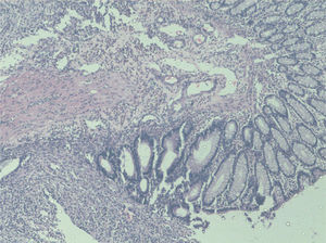 The histopathologic appearance of grade 4 inflammatory cell infiltration in the Control Group (hematoxylin and eosin staining visualized under light microscopy, 40x).