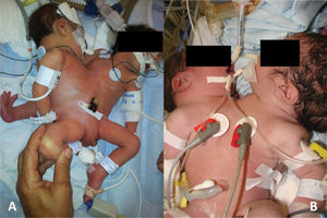 Ischiopagus tripus twins. Note that these twins have two normal legs and a third abnormal leg (patient 14). Figure 1B - Newborn thoracopagus conjoined twins who shared a heart, liver and small intestine (patient 1).
