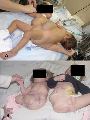 Ischiopagustripus twins. Note the two normal legs and a third abnormal leg (patient 10). Two tissue expanders were used. FigureB - Twins after separation. Note the complete cicatrization of the abdominal wall.