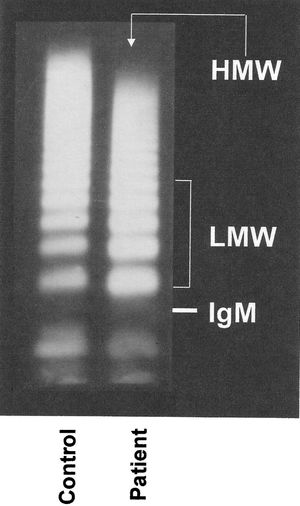 Western immunoblotting of the plasma von Willebrand factor multimeric structure. Compared with the controls, children with cyanotic congenital heart diseases exhibited decreased densities of high-molecular-weight (HMW) multimers and increased concentrations of low-molecular-weight (LMW) fractions (5 bands migrating above the IgM position, 950 kDa), which indicates abnormal proteolytic degradation. This pattern was observed in 36 of the 48 patients (p = 0.0081, densitometric analysis shown in Table 1).