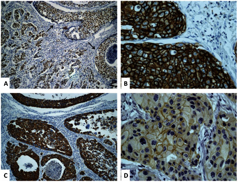 Immunohistochemical profile of high-grade ductal carcinoma in situ of ...