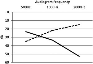 The mean audibility threshold for frequencies of 500, 1000, and 2000 Hz classified according to the type of audiogram slope.