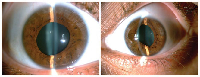 Acute iris depigmentation following systemic moxifloxacin | Clinics