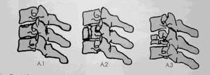 AO classification. A compression: A.1  =  impaction; A.2  =  split; A.3  =  burst.