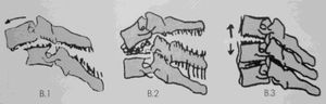 AO classification. B distraction: B.1  =  posterior distraction with vertebral body intact; B.2  =  posterior distraction + fracture of the vertebral body; B.3  =  anterior distraction + hyperextension.