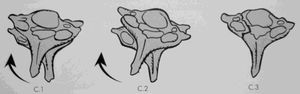 AO classification. C rotation: C.1  =  unilateral facet fracture-dislocation; C.2  =  unilateral facet dislocation; C.3  =  rotational shear injury of the joint mass.