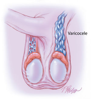 Illustration of left-sided varicocele on physical examination.