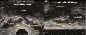 Transrectal imaging of the seminal vesicles