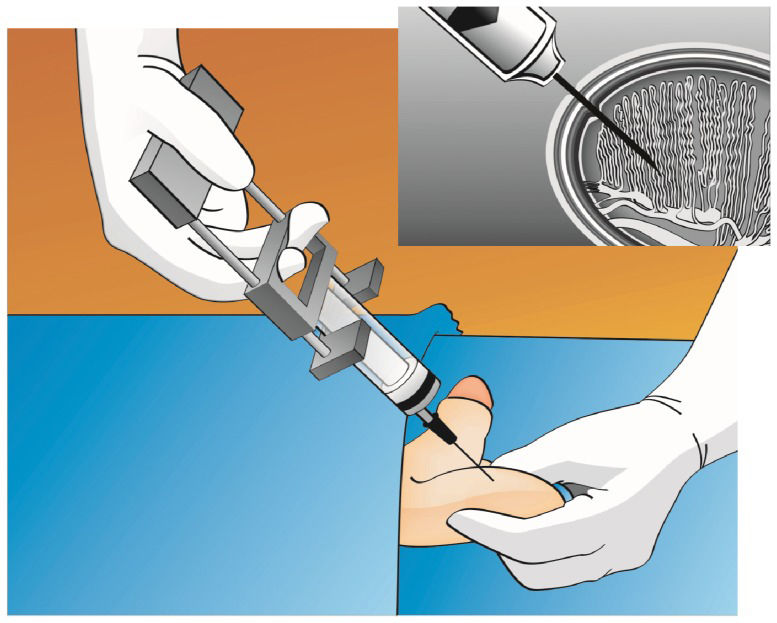 Sperm Extract An update on sperm retrieval techniques for azoospermic males | Clinics