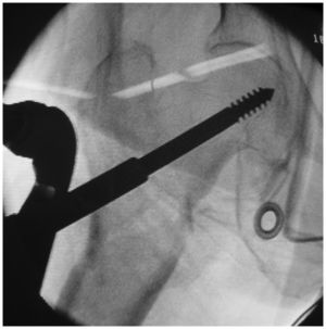 Intraoperative radiograph of one patient. The entrance point avoided the fracture line during the placement of the first neck screw.