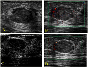 A fibroadenoma found in the left breast of a 47-year-old woman. A) Gray-scale image showing an irregular, microlobulated mass (BI-RADS 4). B) Color Doppler image showing a peripheral regular artery. C) After contrast injection, we observed moderate peripheral enhancement. D) An enhanced color Doppler image showing the same aspect as that shown for the non-enhanced color Doppler image in B. No additional arteries were observed. Power Doppler imaging was used only to produce clearer images for illustration purposes.