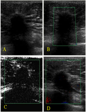 An invasive ductal carcinoma recurrence in the left breast of a 63-year-old woman. A) A gray-scale image showing an irregular, spiculated mass with an echogenic halo, architectural distortion, acoustic shadowing, and straightening of Cooper's ligament (BI-RADS 5). B) A color Doppler image showing an avascular lesion. C) After contrast injection, there was minimal enhancement. D) An enhanced color Doppler image showing an avascular lesion.
