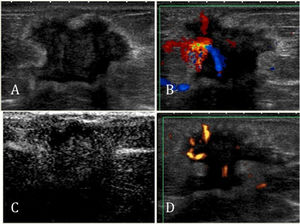 An invasive ductal carcinoma in the right breast of a 71-year-old woman. A) A gray-scale image showing an irregular, microlobulated mass with an echogenic halo and acoustic shadowing (BI-RADS not 3). B) A color Doppler image showing a hypervascular lesion with central and irregular arteries. C) After contrast injection, there was intense enhancement. D) An enhanced color Doppler image showed the same pattern as the unenhanced CDUS. Power Doppler imaging was used only to produce clearer images for illustration purposes.