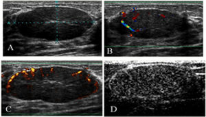 Juvenile fibroadenoma in the left breast of an 18-year-old woman. A) A gray-scale image showing an oval, circumscribed mass (BI-RADS 3). B) A color Doppler image showing a hypervascular lesion with central and regular arteries. C) An enhanced color Doppler image showed the same pattern as the unenhanced CDUS. Power Doppler imaging was used only to produce clearer images for illustration purposes. D) After contrast injection, there was intense enhancement.