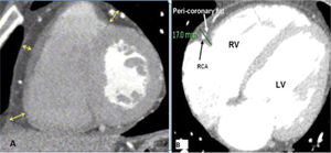 A) Epicardial fat thickness (yellow arrows). B) Pericoronary fat thickness (green). LV = left ventricle; RCA = right coronary artery; RV = right ventricle.